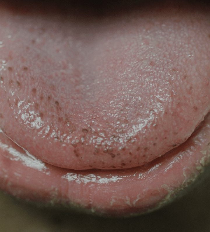 Decoding What Black Spots On Tongue Mean